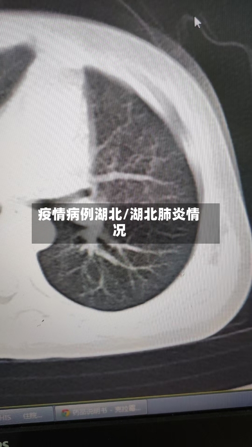 疫情病例湖北/湖北肺炎情况-第2张图片